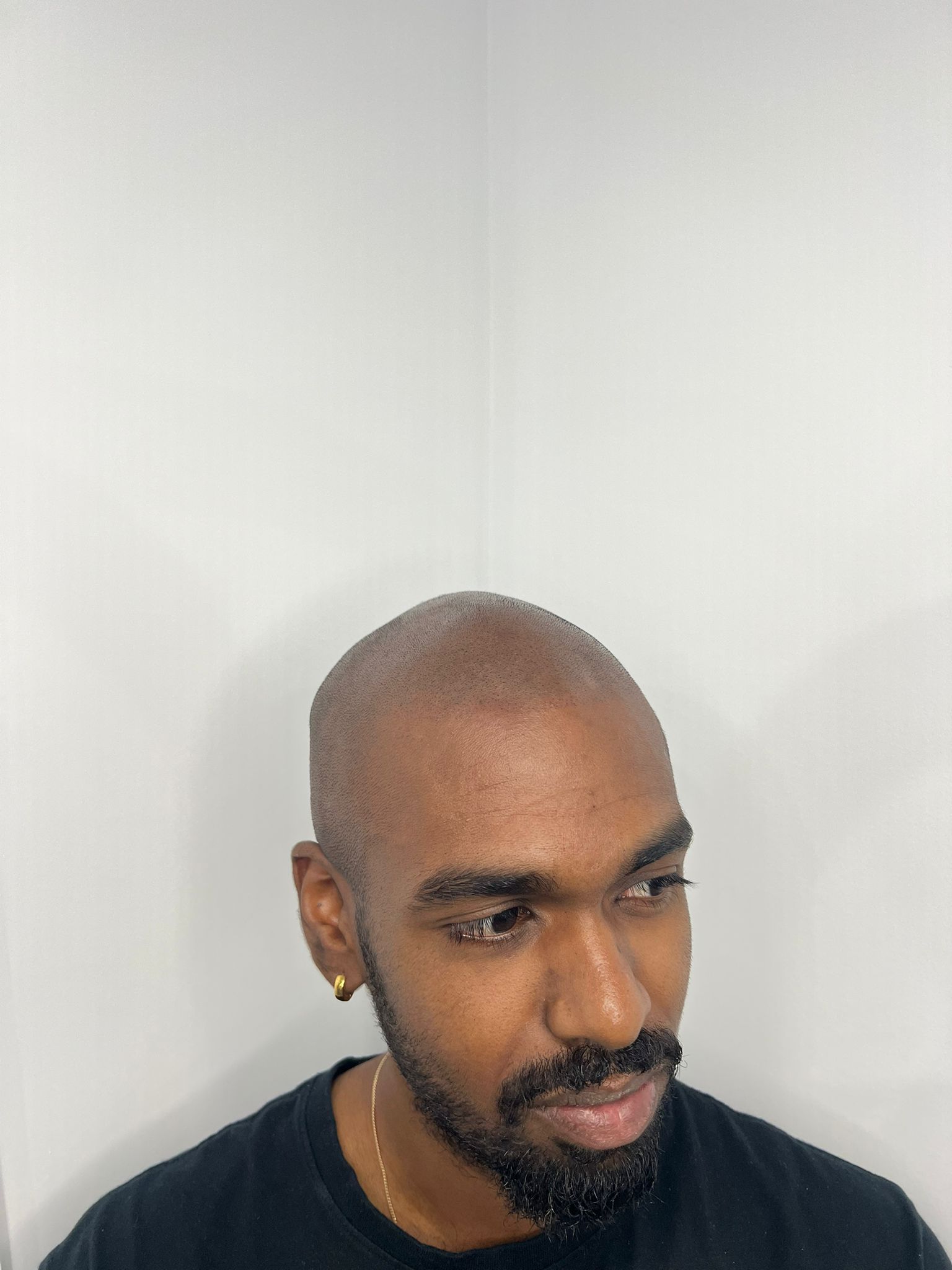 Hairline Restoration